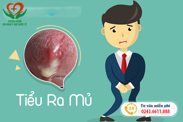 Tiểu ra mủ có phải bệnh lậu không ?