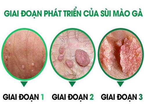 [Cần Biết] Dấu hiệu, triệu chứng mắc bệnh sùi mào gà