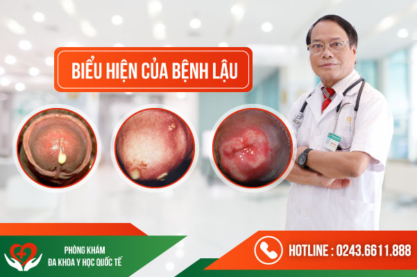 Chi Phí Điều Trị Bênh Lậu Hết Bao Nhiêu Tiền