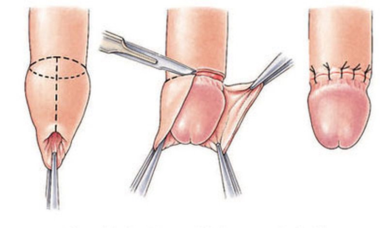 Cơ Sở Y Tế Cắt Bao Quy Đầu Tốt Nhất Hà Nội Chỉ Với 1.5 Triệu