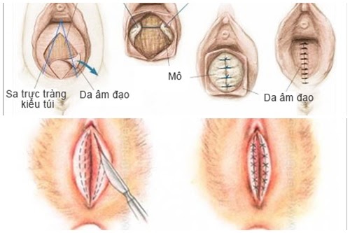 Thẩm mỹ cắt môi bé – lấy lại tuổi thanh xuân